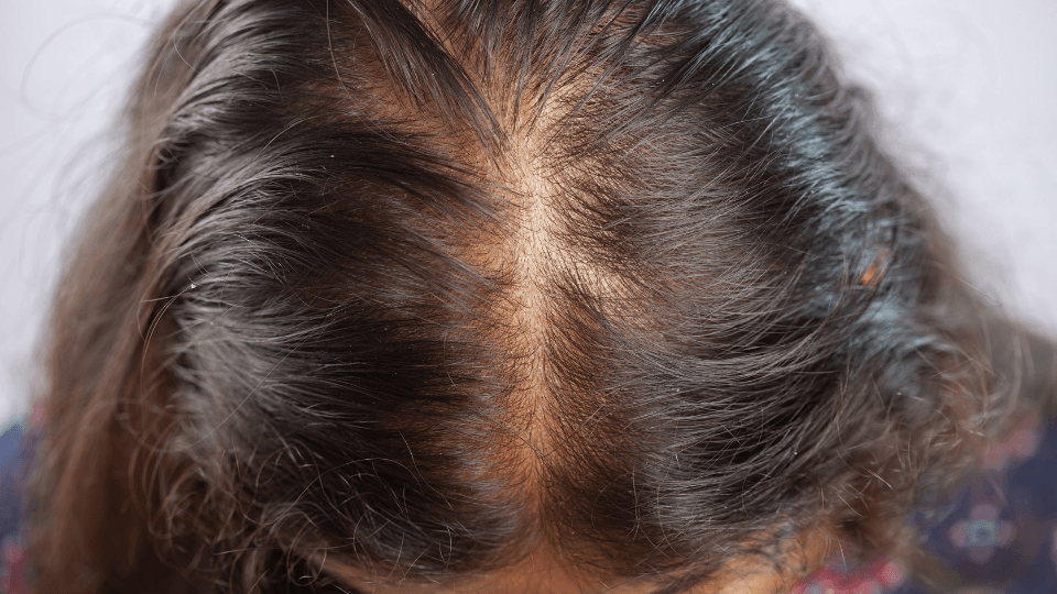 Rambut tipis dan lemah